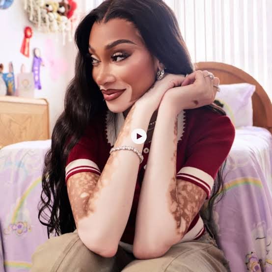 Winnie Harlow